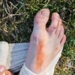 Can You Run With a Broken Pinky Toe?