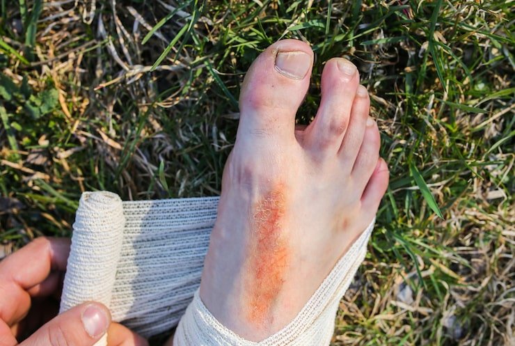 Can You Run With a Broken Pinky Toe?